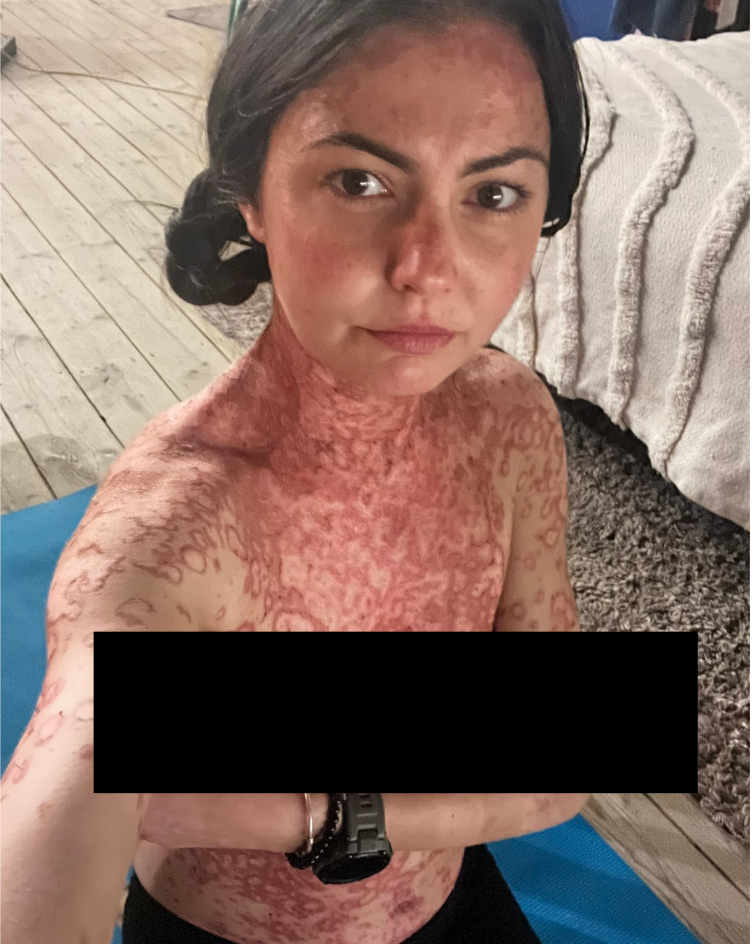 Puseu inflamator sever